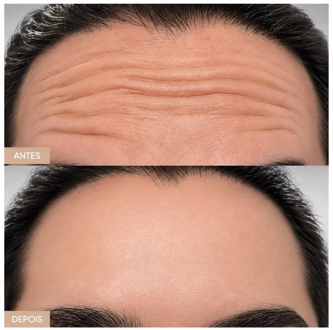 Antes e depois — Botox — suavização de linhas de expressão