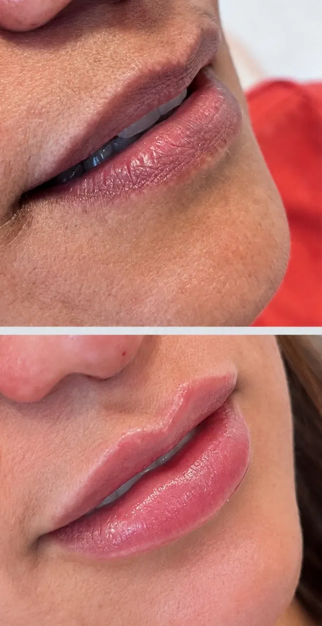 Antes e depois — Preenchimento labial