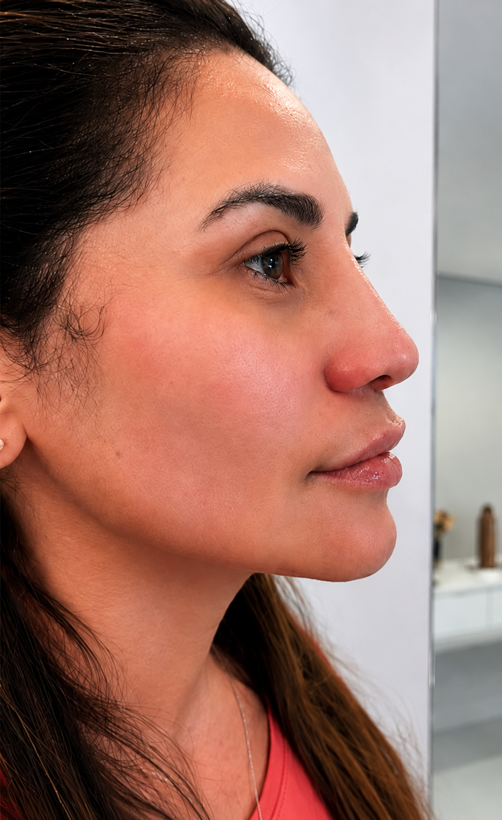 Perfiloplastia — depois