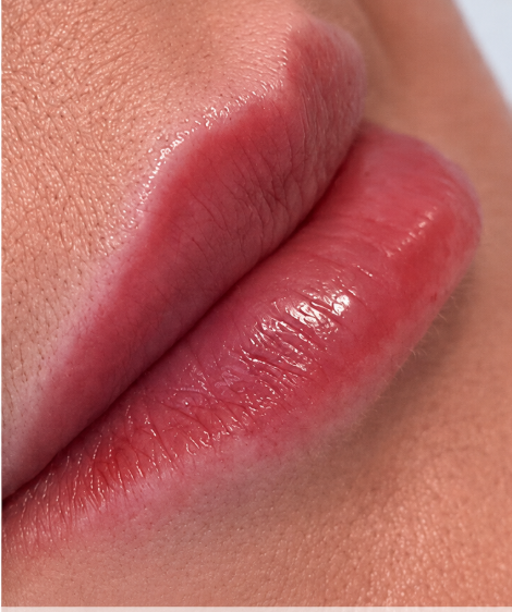Preenchimento labial — depois
