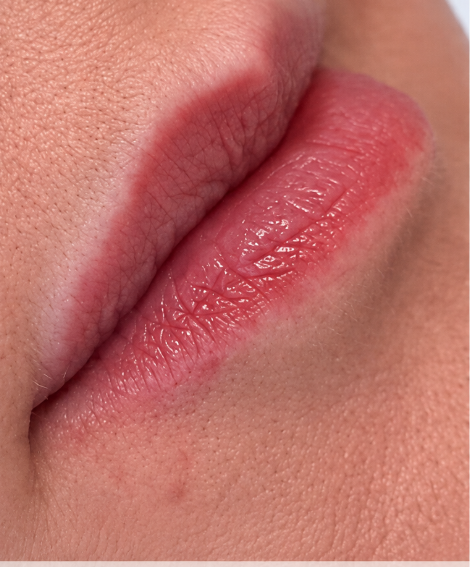 Preenchimento labial — antes